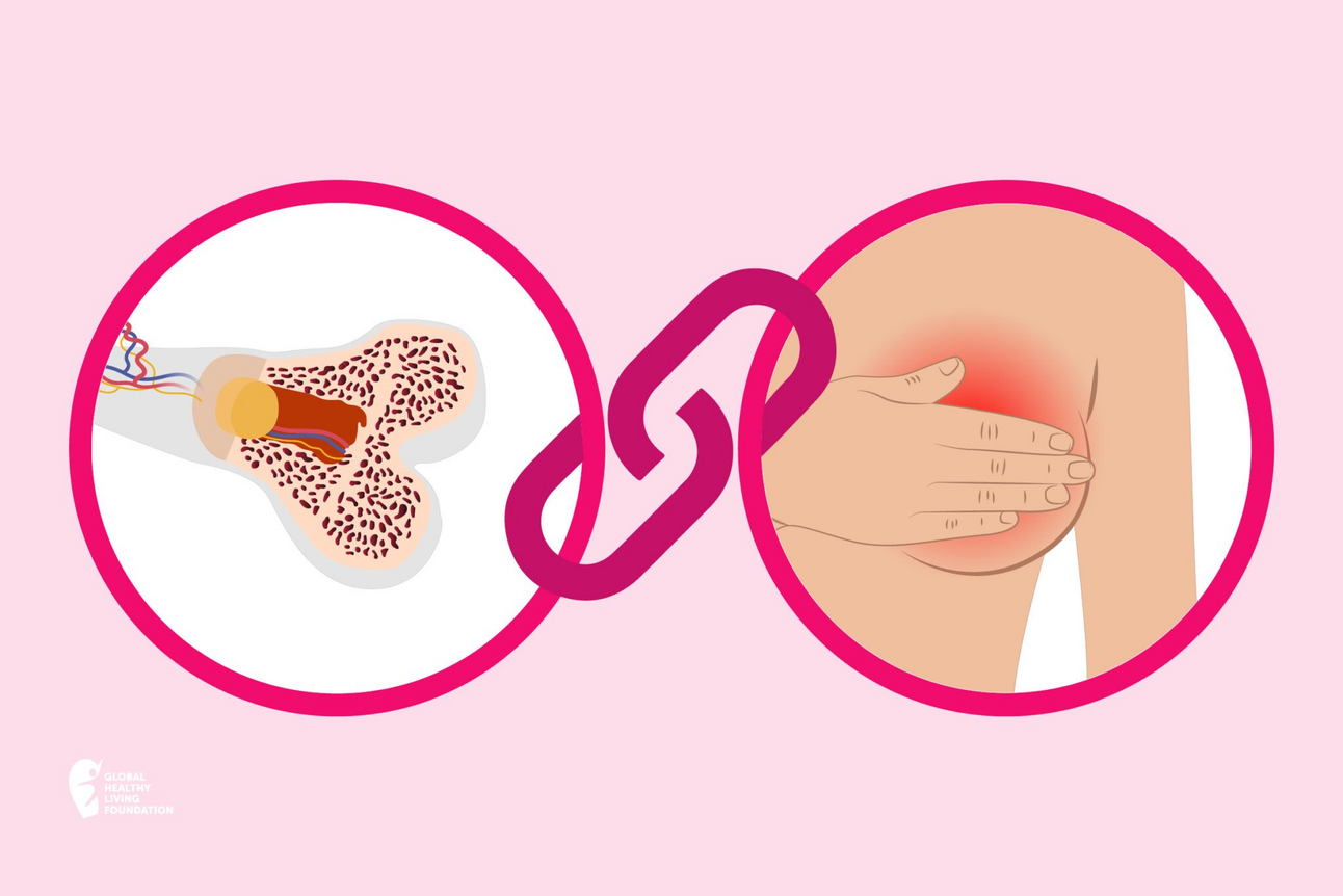 🦴 Osteoporosis y cáncer de mama: lo que debes saber para cuidar tus huesos
