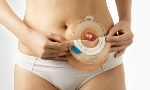 Vivir con una colostomía o una ileostomía: Lo que necesitas saber para sentirte más seguro