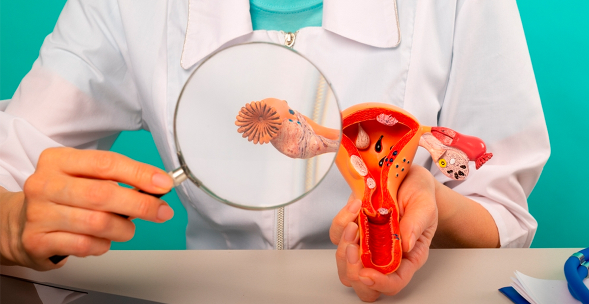 “¿Y ahora qué?”: Vida después del tratamiento de cáncer de ovario