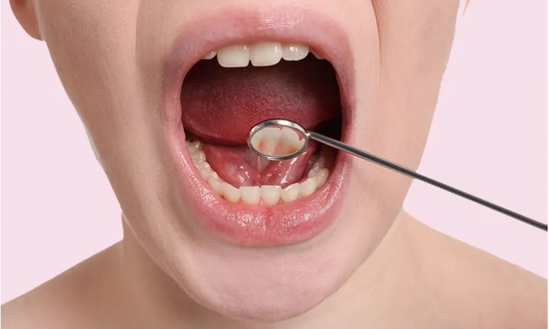 🦷 Cuida tu boca durante el tratamiento oncológico: Lo que necesitas saber