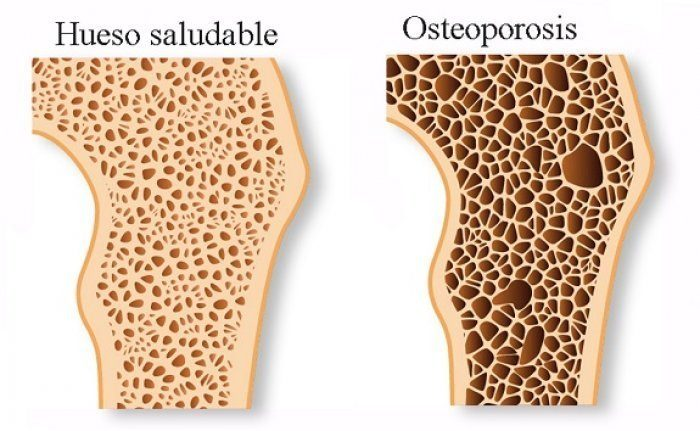 ¿Te recetaron Anastrozol o Letrozol? Así puedes proteger tus huesos de la osteoporosis