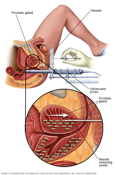 Braquiterapia: una forma eficaz y precisa de tratar el cáncer desde adentro