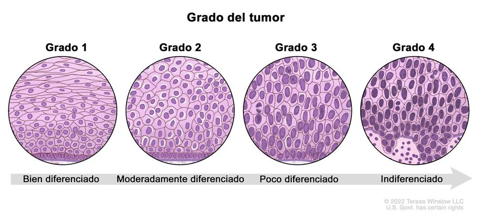 ¿Qué significa que mi cáncer está en grado 1, 2 o 3? ¿Es lo mismo que la etapa?