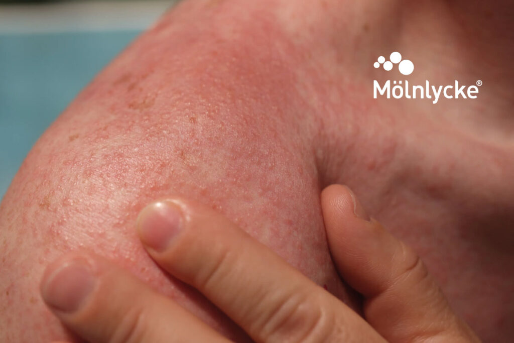 ¿Qué es la “radiodermitis” y cómo cuidar tu piel durante la radioterapia?