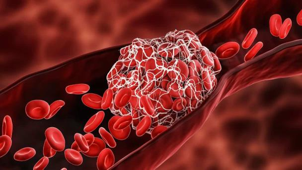 🩸¿Por qué algunos pacientes tienen más riesgo de coágulos de sangre durante el cáncer?