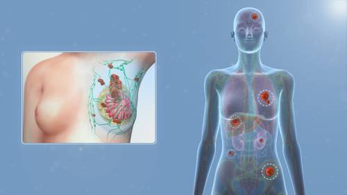 🌿 ¿Qué significa que mi cáncer es “metastásico pero controlado”?