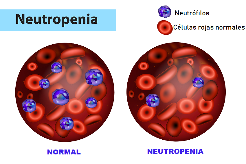 🌡️ Neutropenia febril: por qué la fiebre en pacientes con quimio es siempre una urgencia