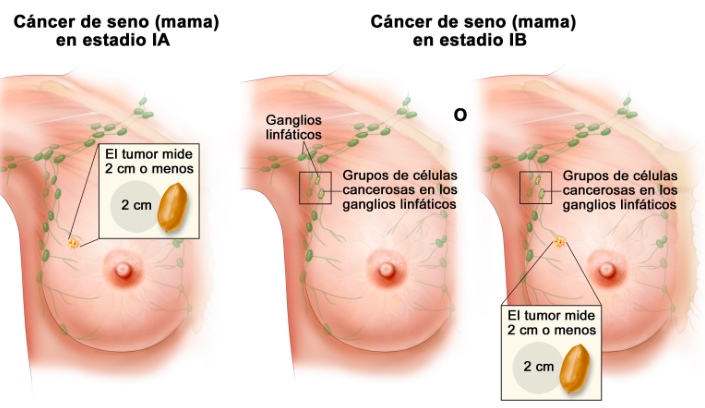¿Qué significa que mi cáncer sea “localmente avanzado”?