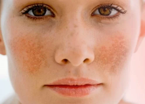 Cambios en la piel o manchas oscuras durante la quimioterapia: ¿cuándo preocuparse y cuándo es algo temporal?