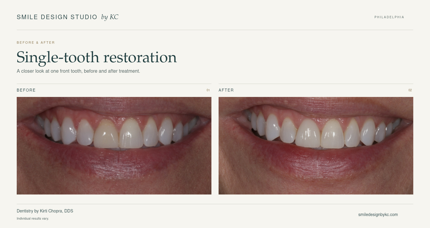 Single veneer case - Smile Design Studio by KC
