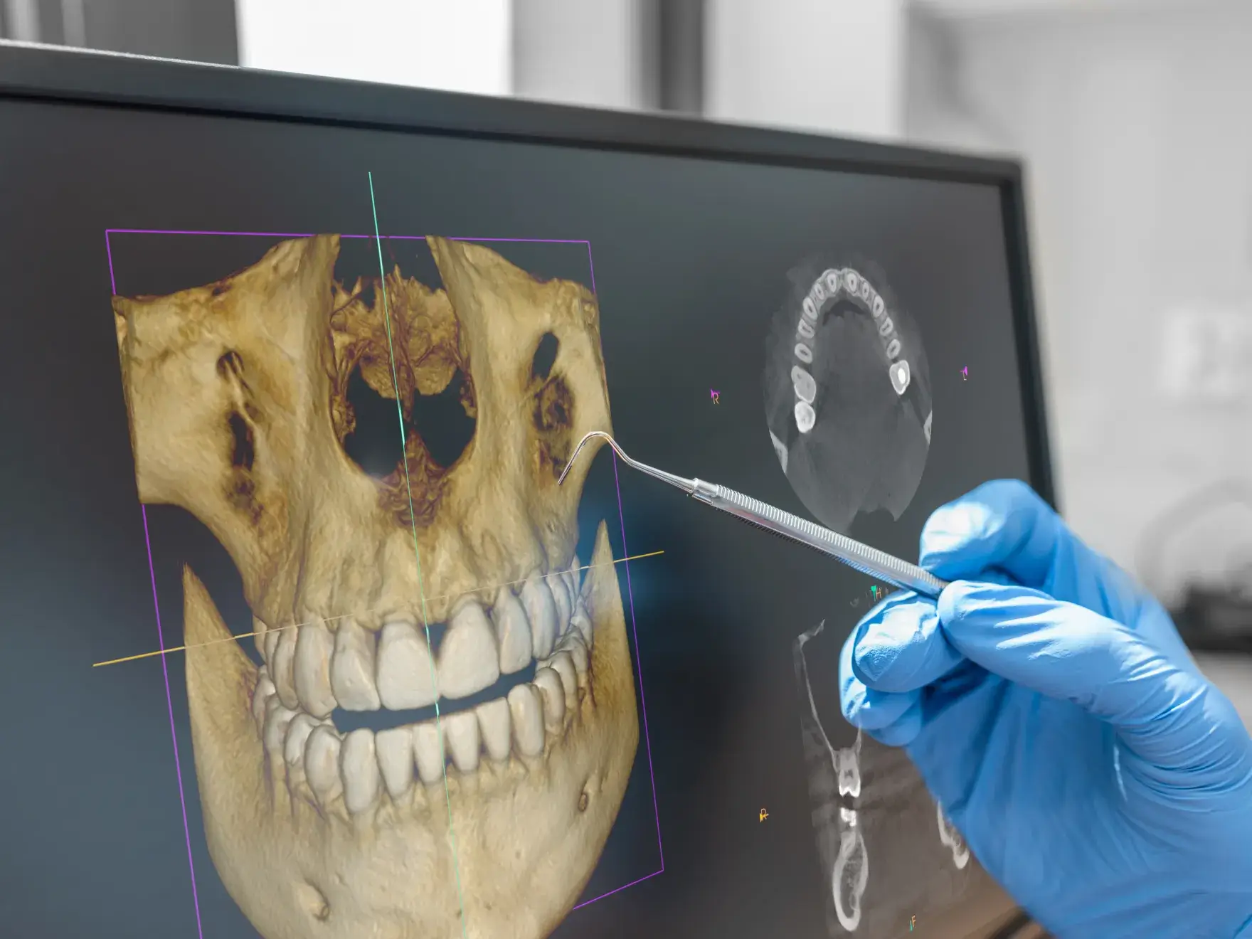 A gloved hand points at a 3D skull scan on a computer screen with a dental tool.