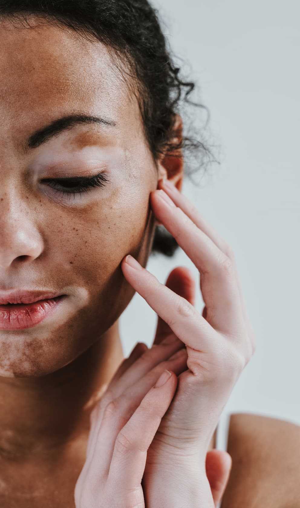 Mujer de piel morena con vitiligo