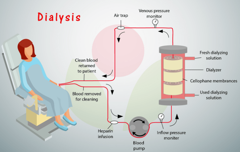 Can Dialysis Be Temporary