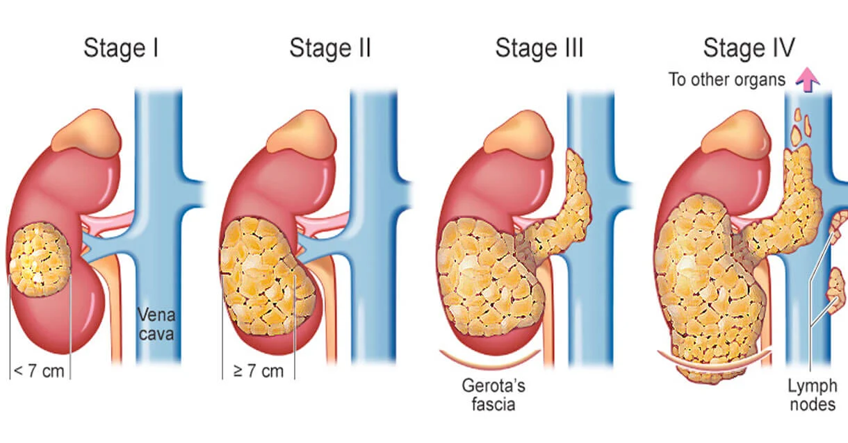 Stage 4 of Chronic Kidney Disease
