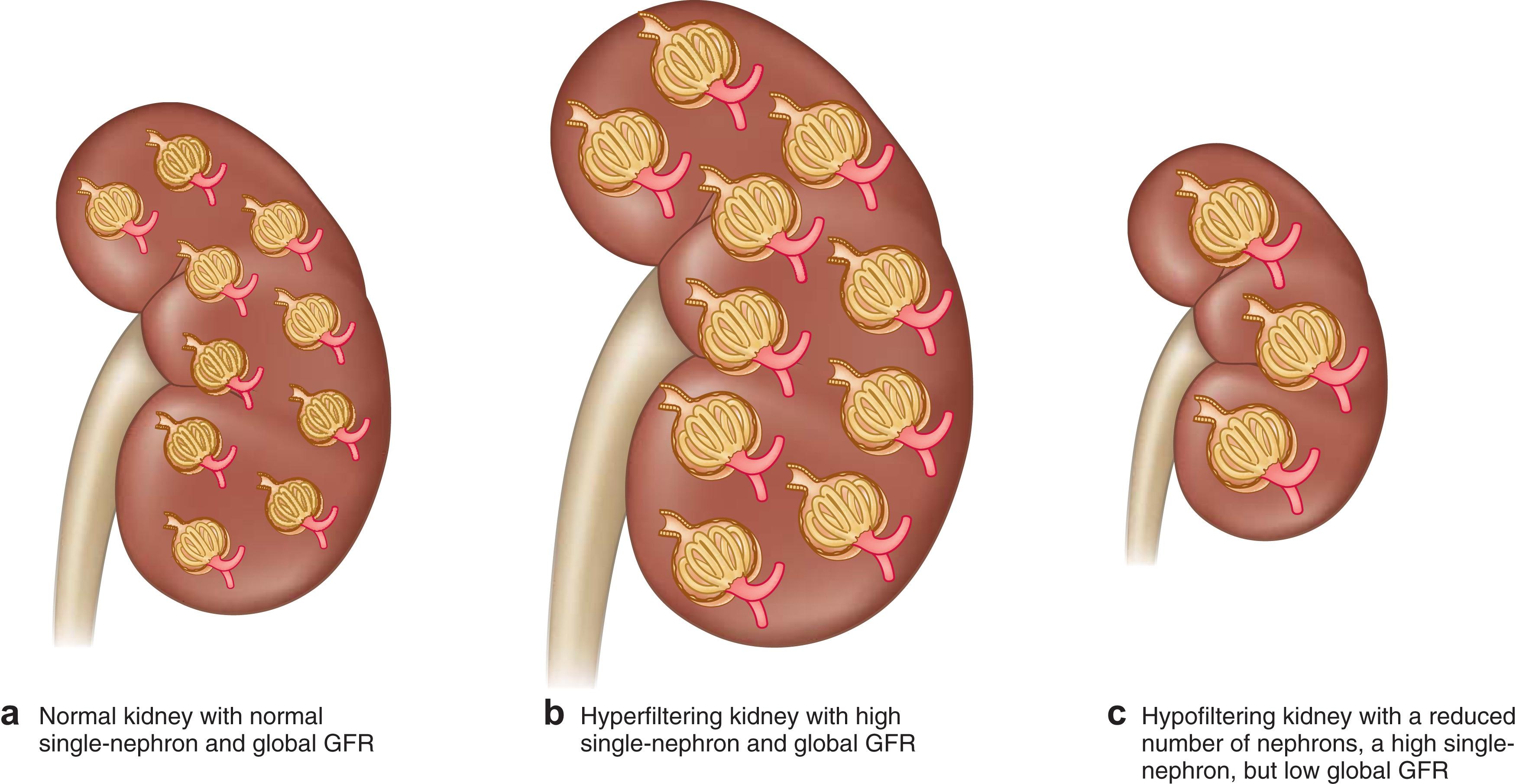 What is Hyperfiltration