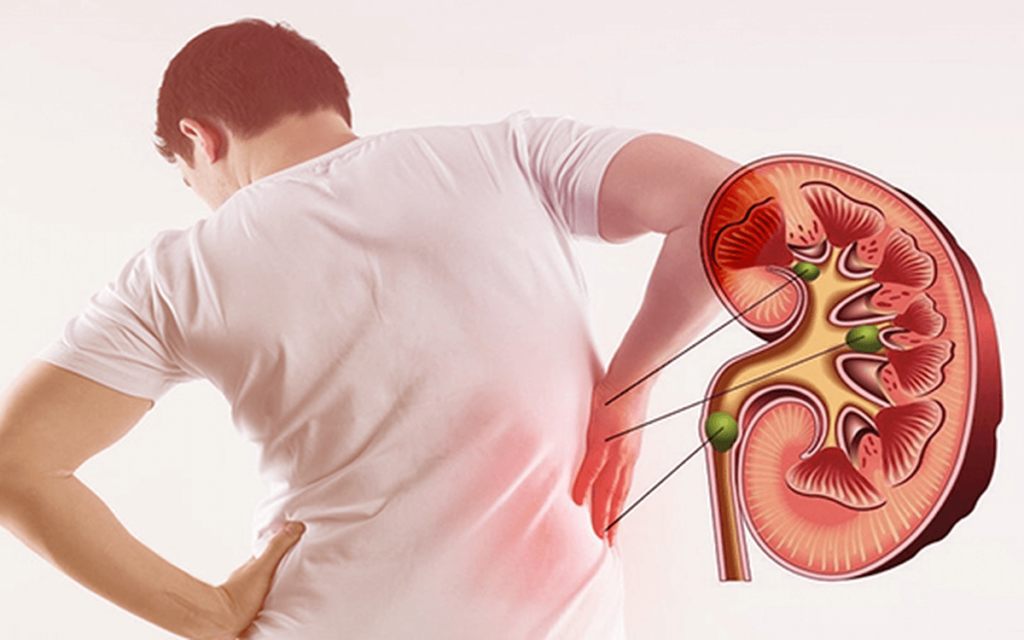 Lifestyle Changes for Kidney Stone Prevention