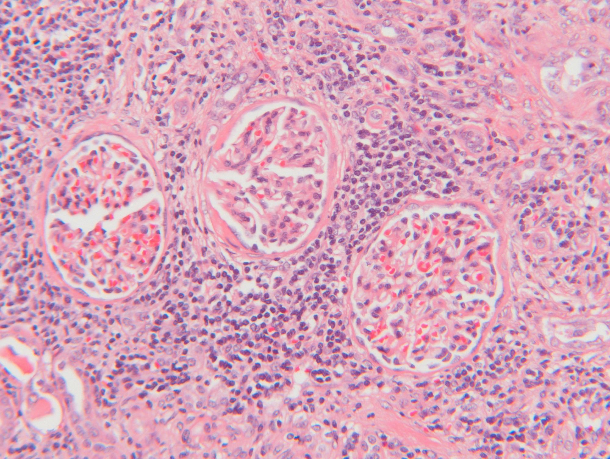 How Quickly Does Lupus Nephritis Progress