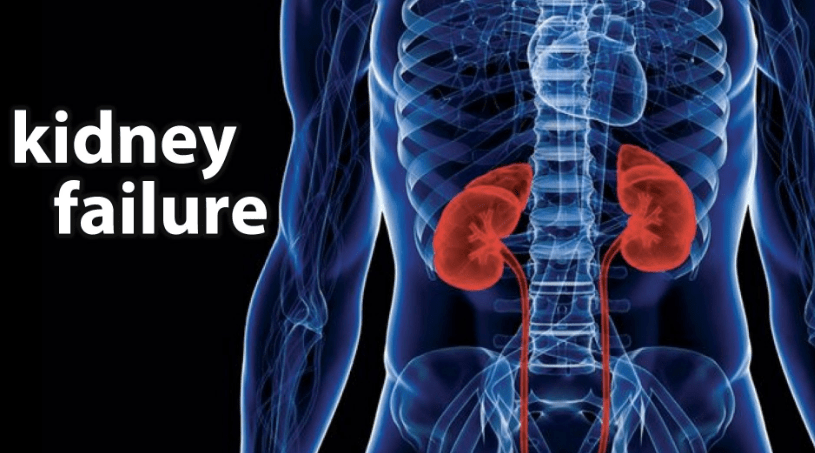 Diagnosing Lupus-Induced Kidney Failure