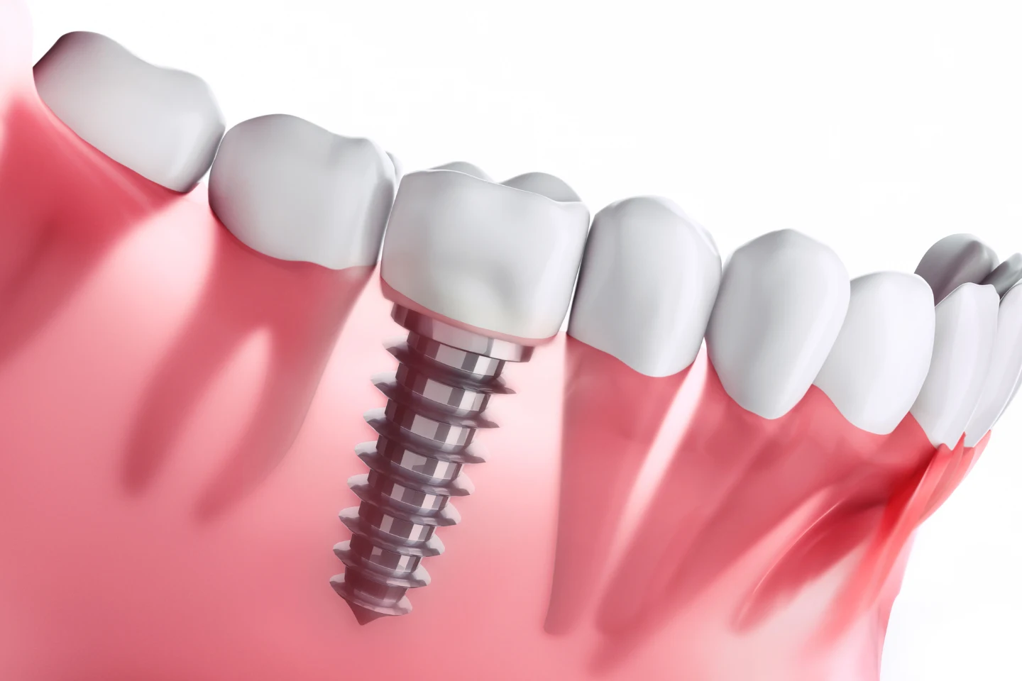 Why Dental Implants Are the Gold Standard for Replacing Missing Teeth