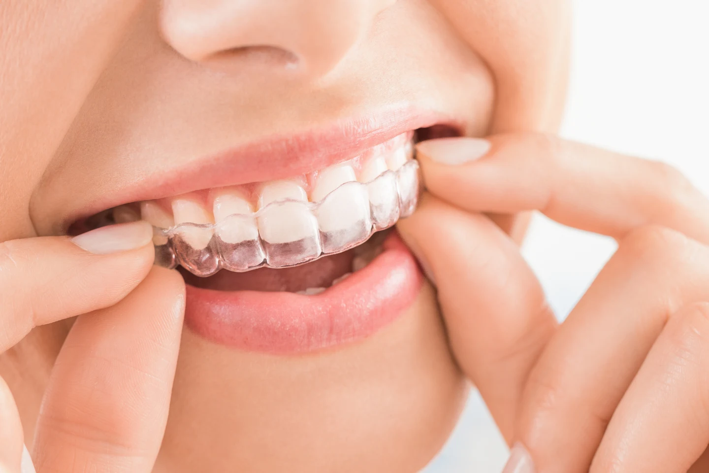 Why Invisalign® Is the Clear Choice for Straightening Teeth