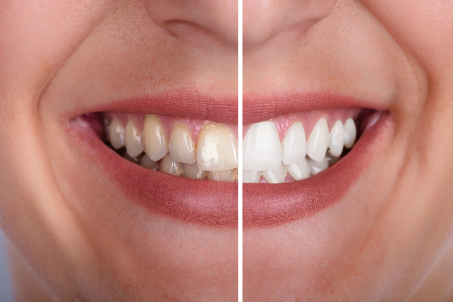 Why Professional Teeth Whitening in Leeds Beats DIY Kits Every Time