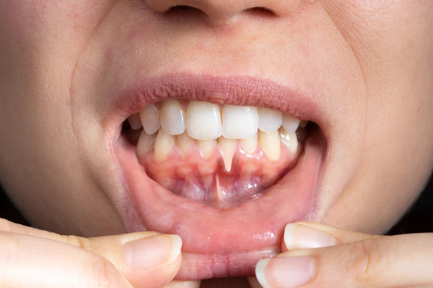 The Complete Guide to Preventing Gum Disease