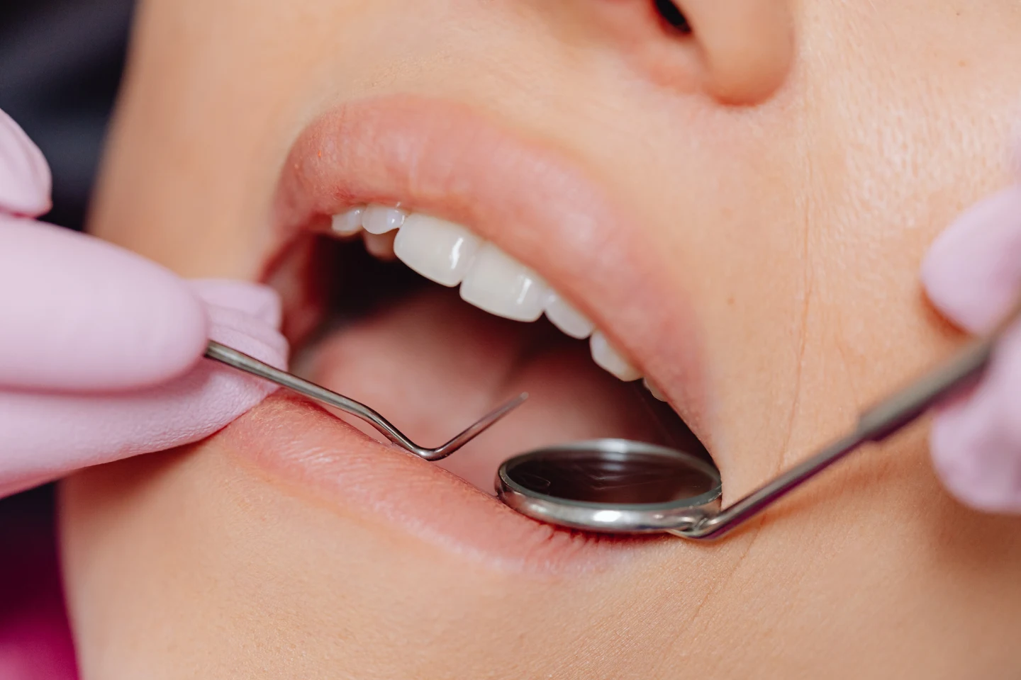 Does Composite Bonding Hurt? What Patients in Leeds Should Know