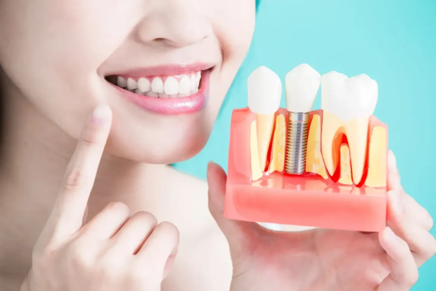 What Is the Difference Between Dental Implants and Veneers?