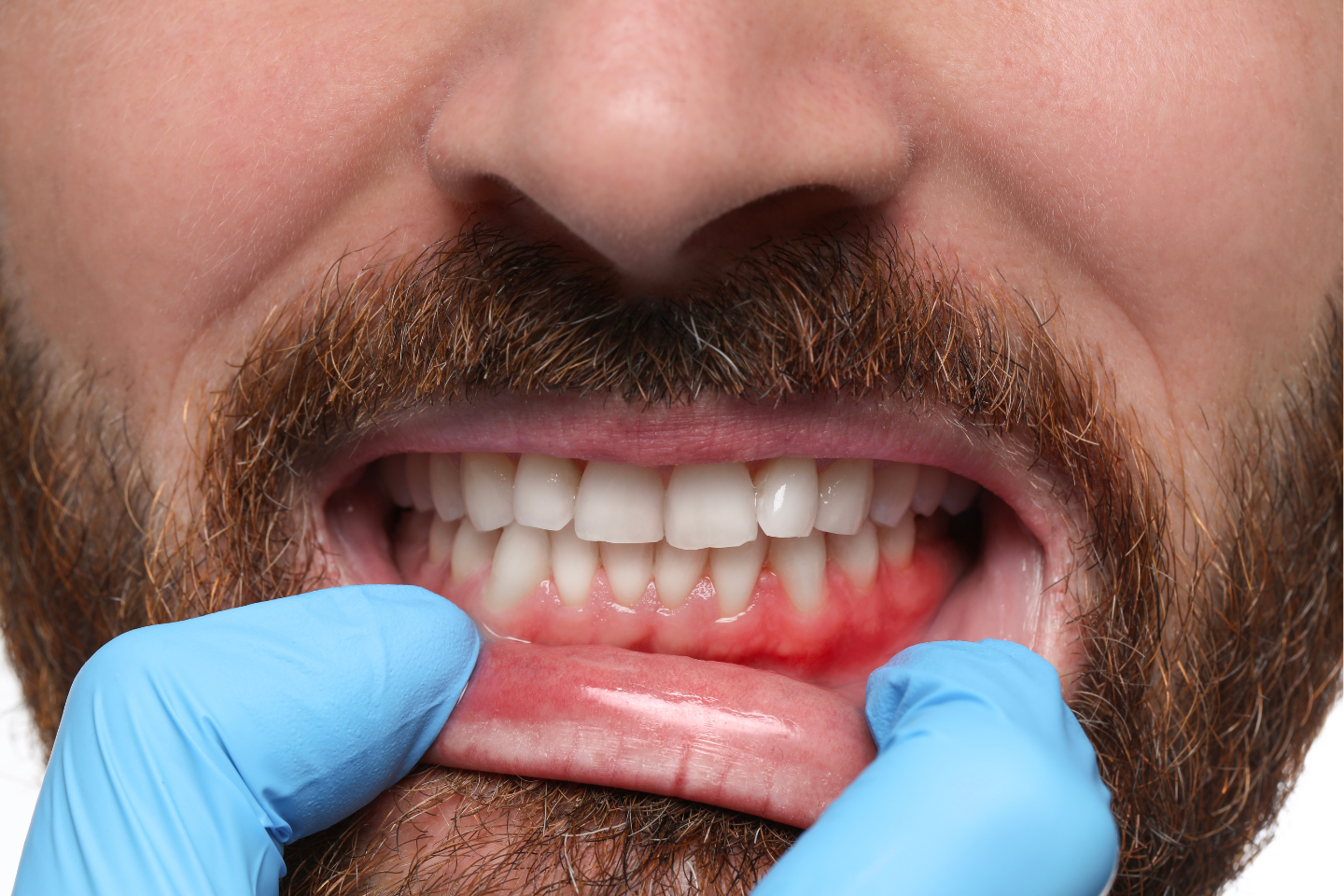 Can You Have Composite Bonding with Gum Disease?