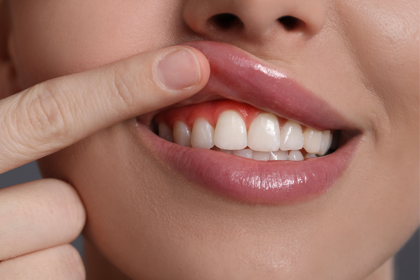 Can You Have Veneers with Gum Disease?