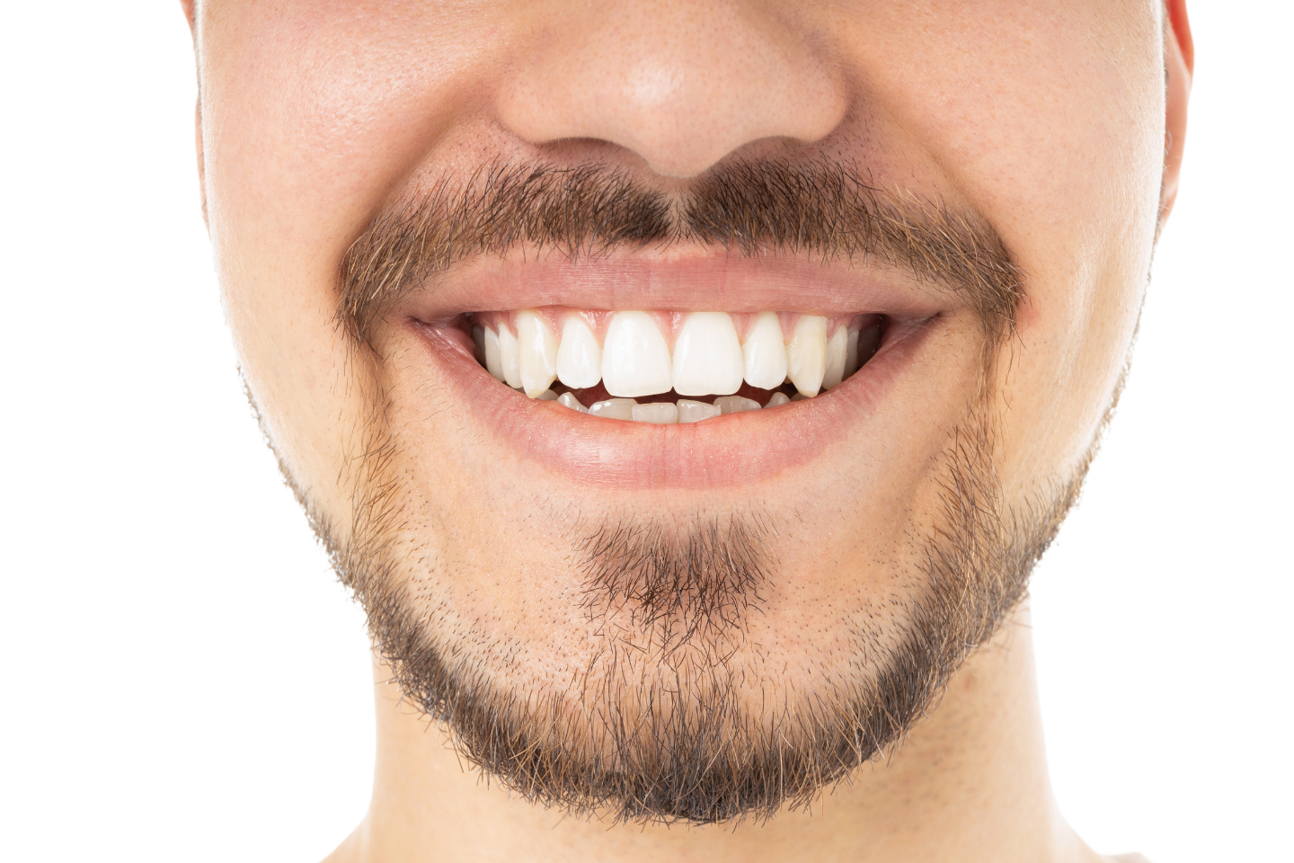 Can You Get Composite Bonding on Crooked Teeth?