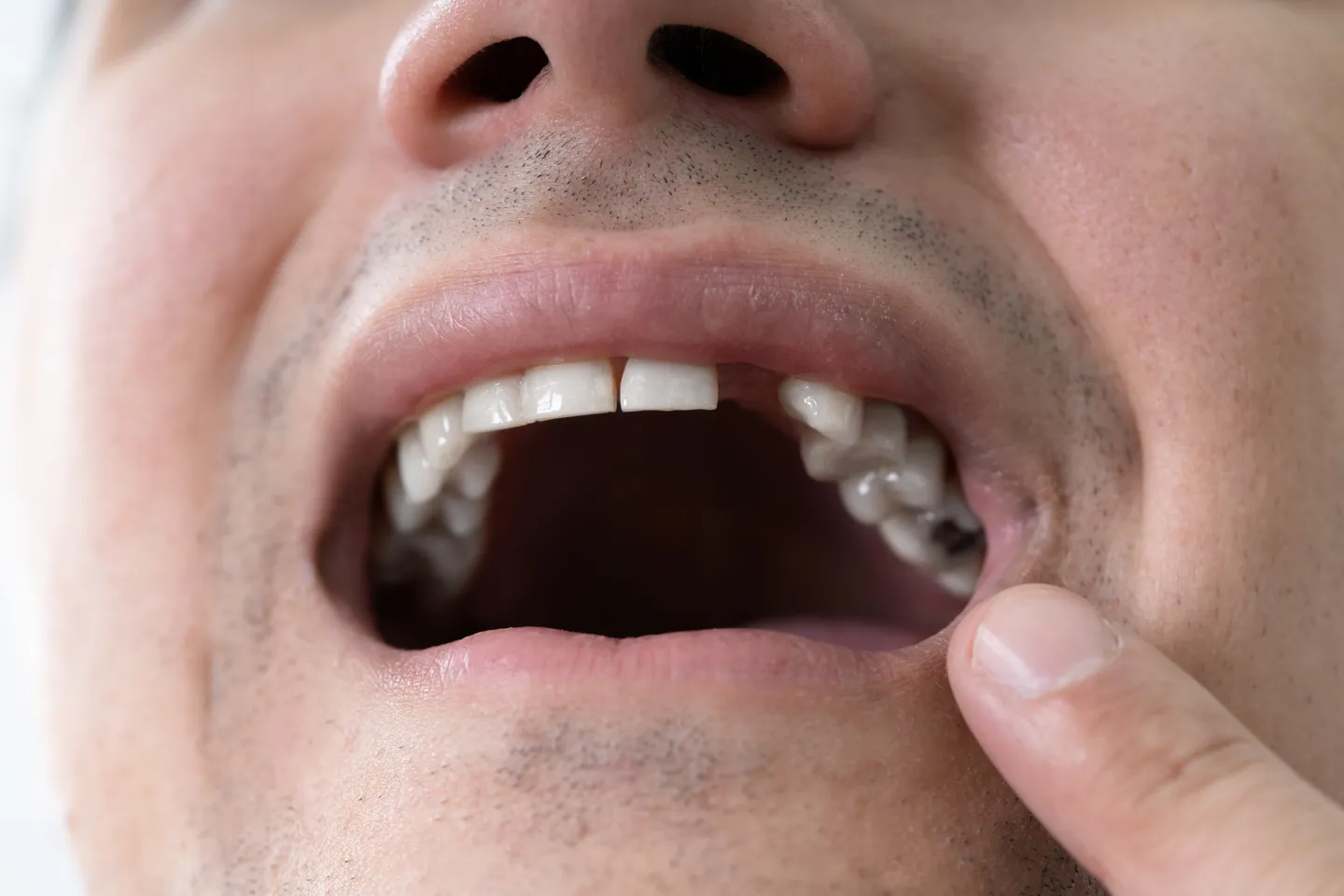 Dentist for Missing Teeth in Leeds