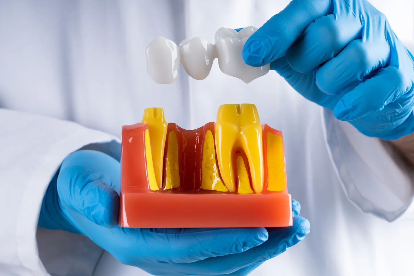 Dental Crowns and Bridges in Leeds