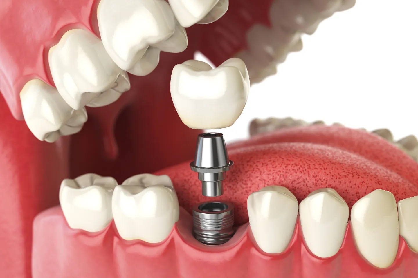 The Priceless Benefits of Replacing Missing Teeth With Dental Implants - Meliora Dental | Dentist in Leeds, Yorkshire