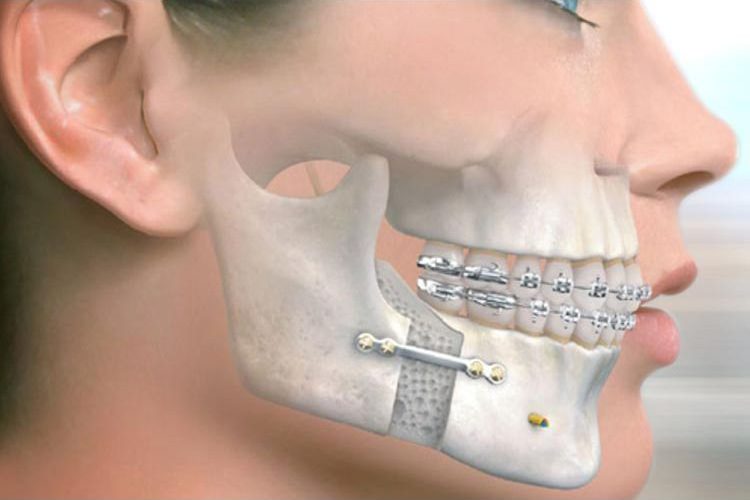 Çene Kırığı Tedavisi