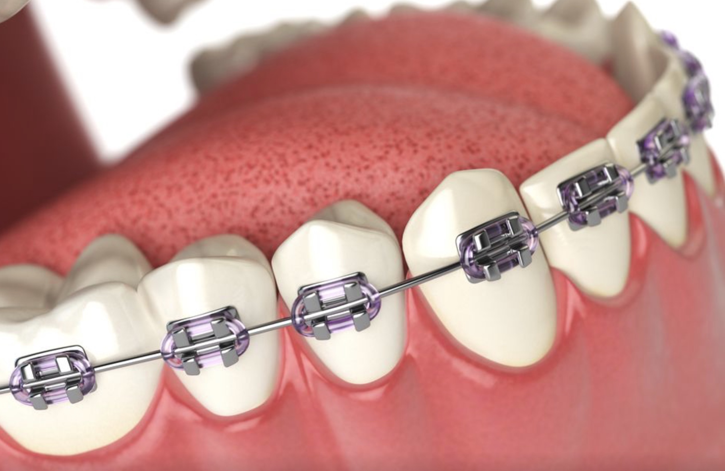 Ortodontik diş teli ve şeffaf braketlerin dişler üzerindeki görünümü, ortodonti tedavisi detaylı görünüm