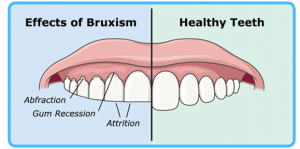The effects of bruxism