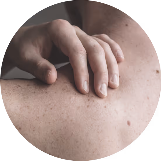Mole on back. 
