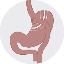 Gastric Bypass. 