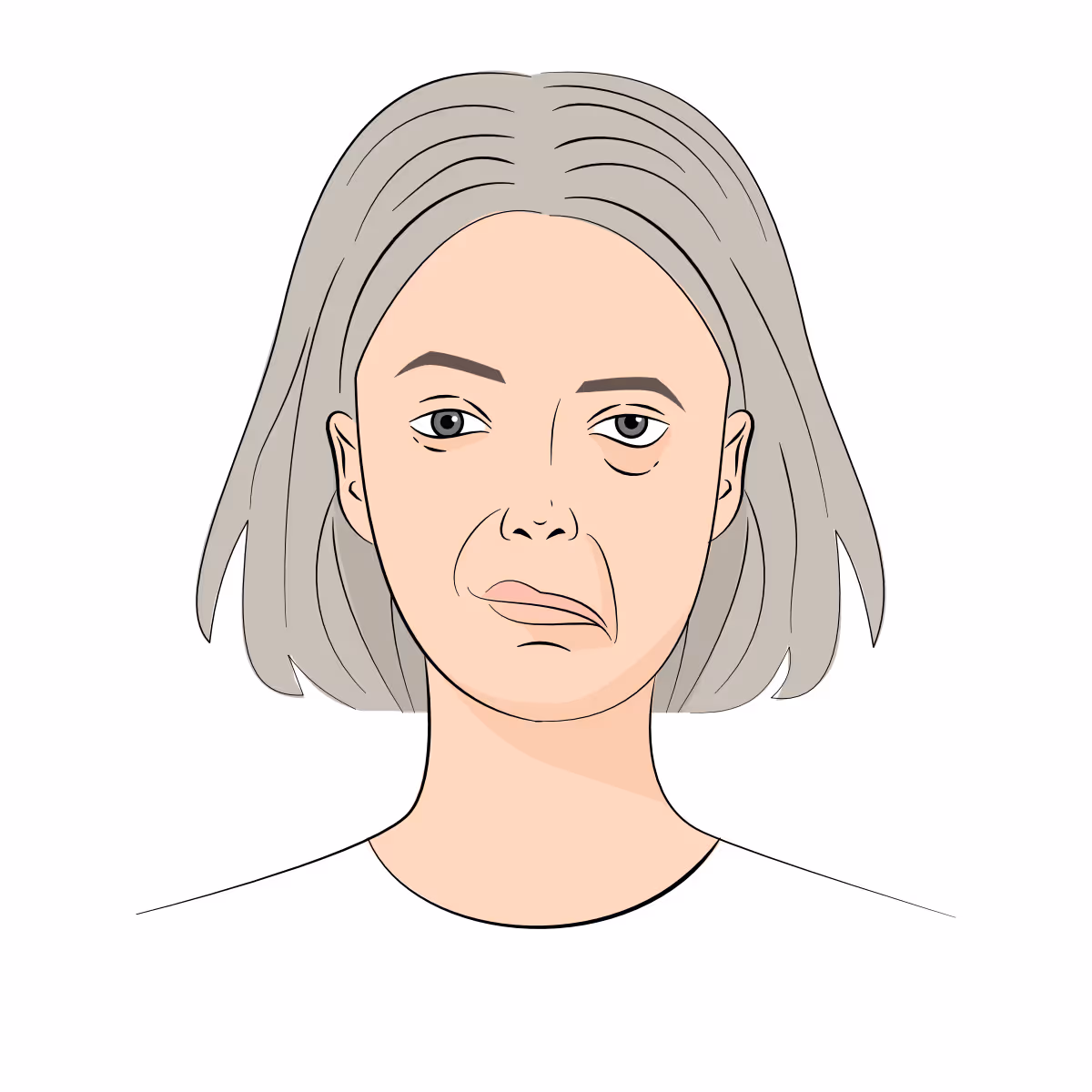 Female face with facial palsy.