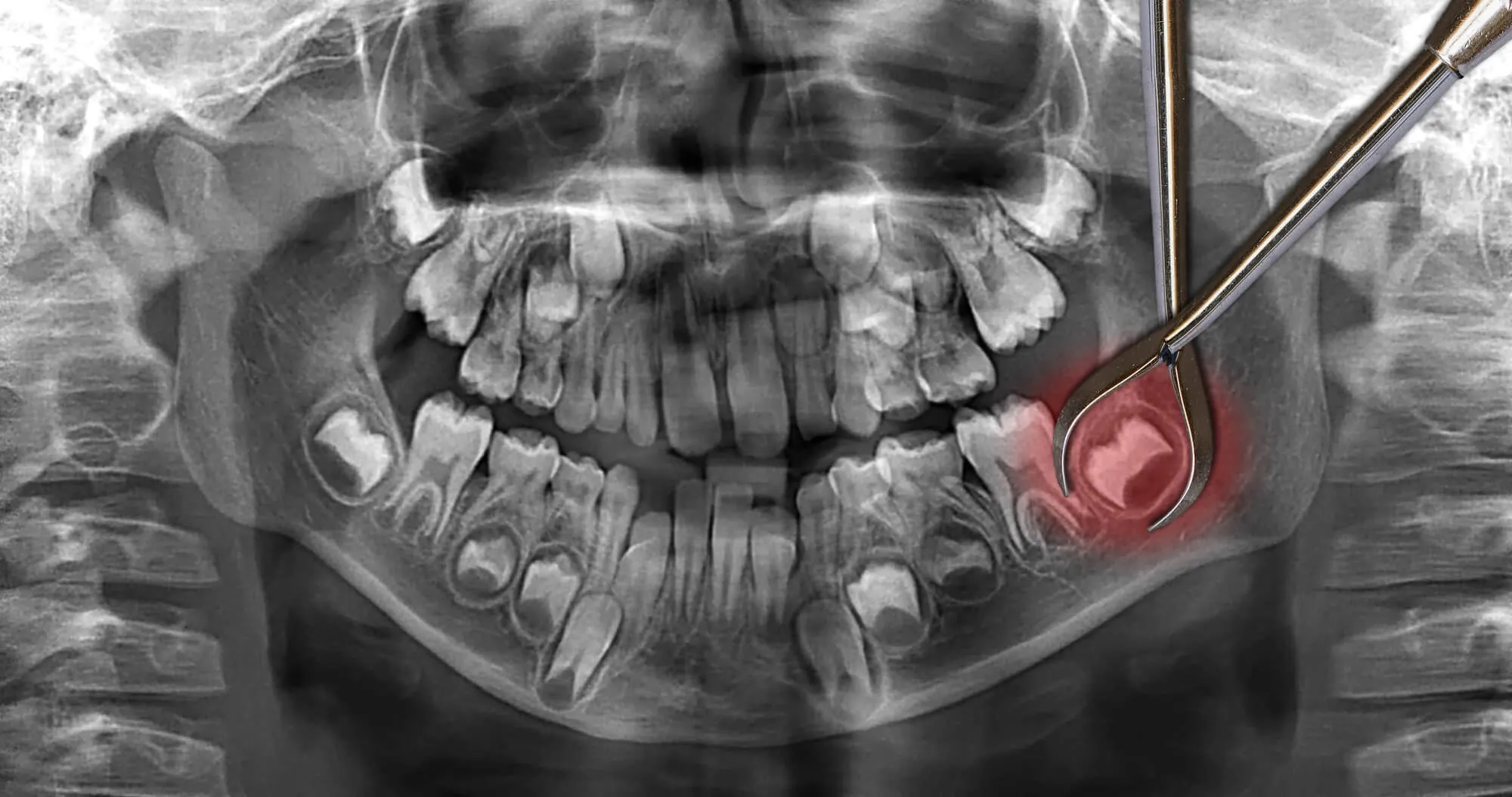 wisdom tooth extraction foley al xray image