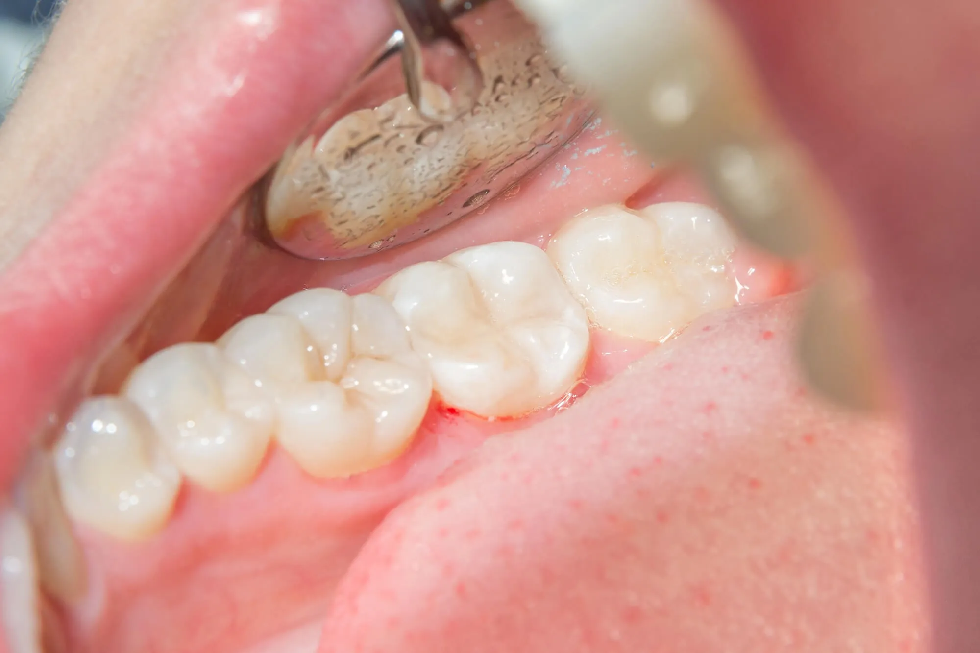 tooth filling foley al