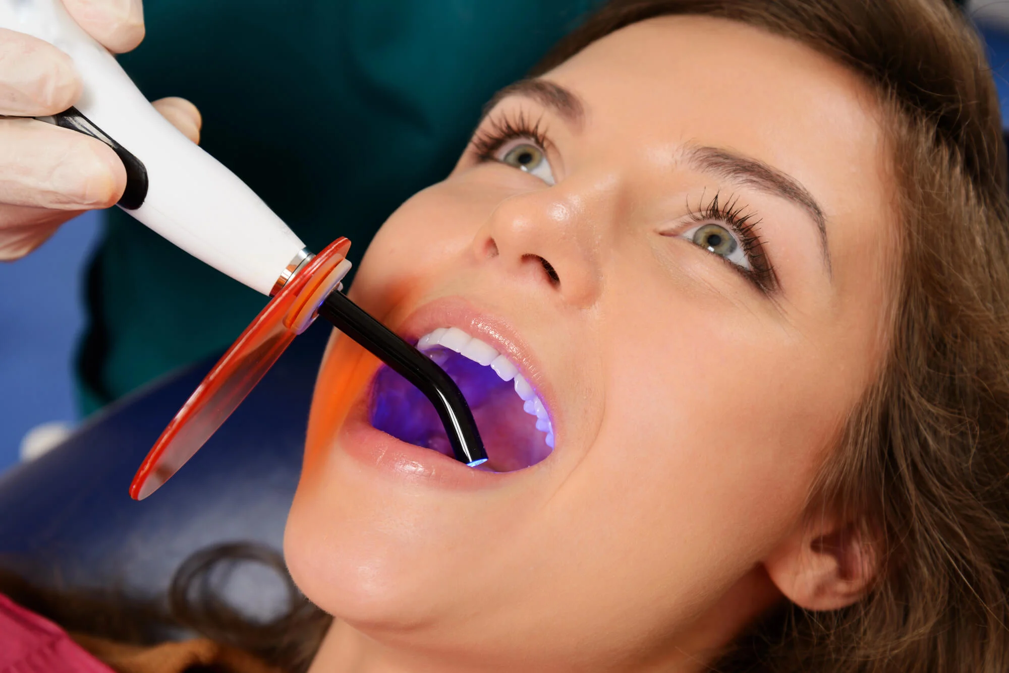 Curing a tooth filling in Foley, AL