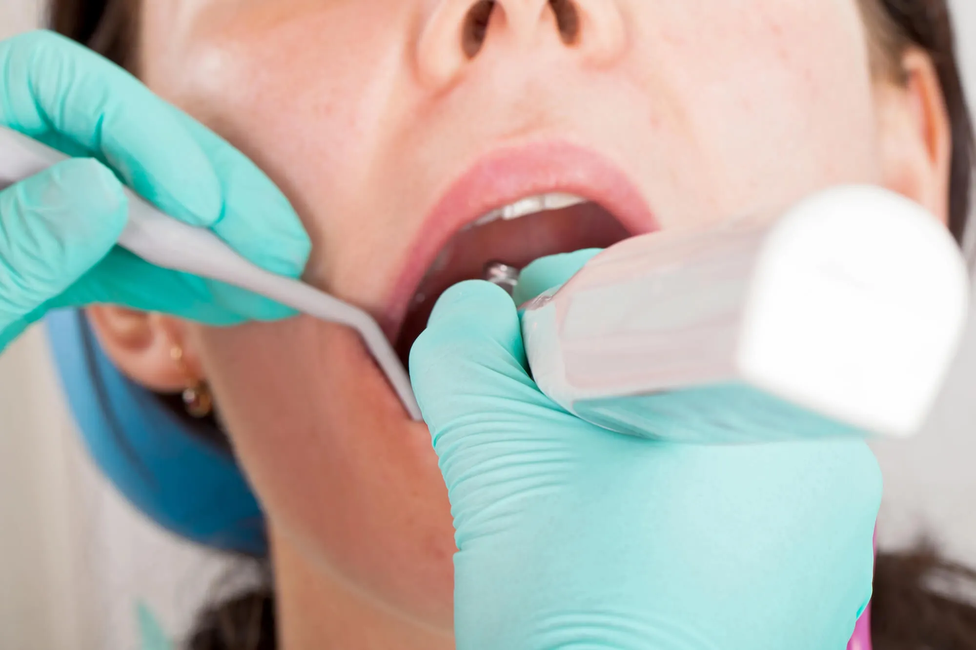 emergency dentist spartanburg sc fixing a cracked tooth