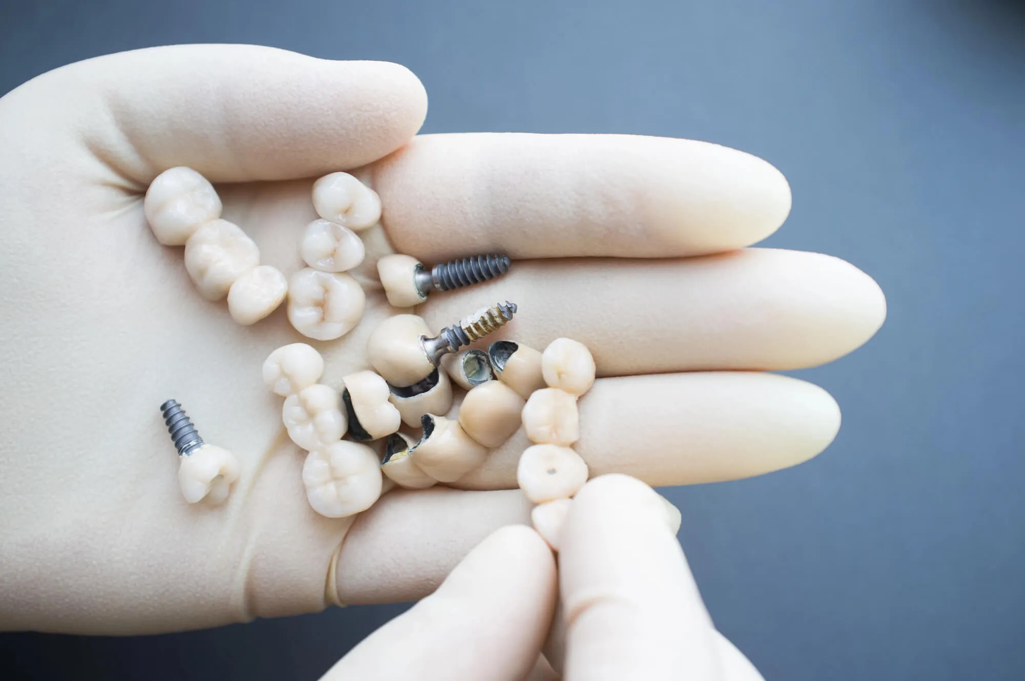 dental implants spartanburg sc