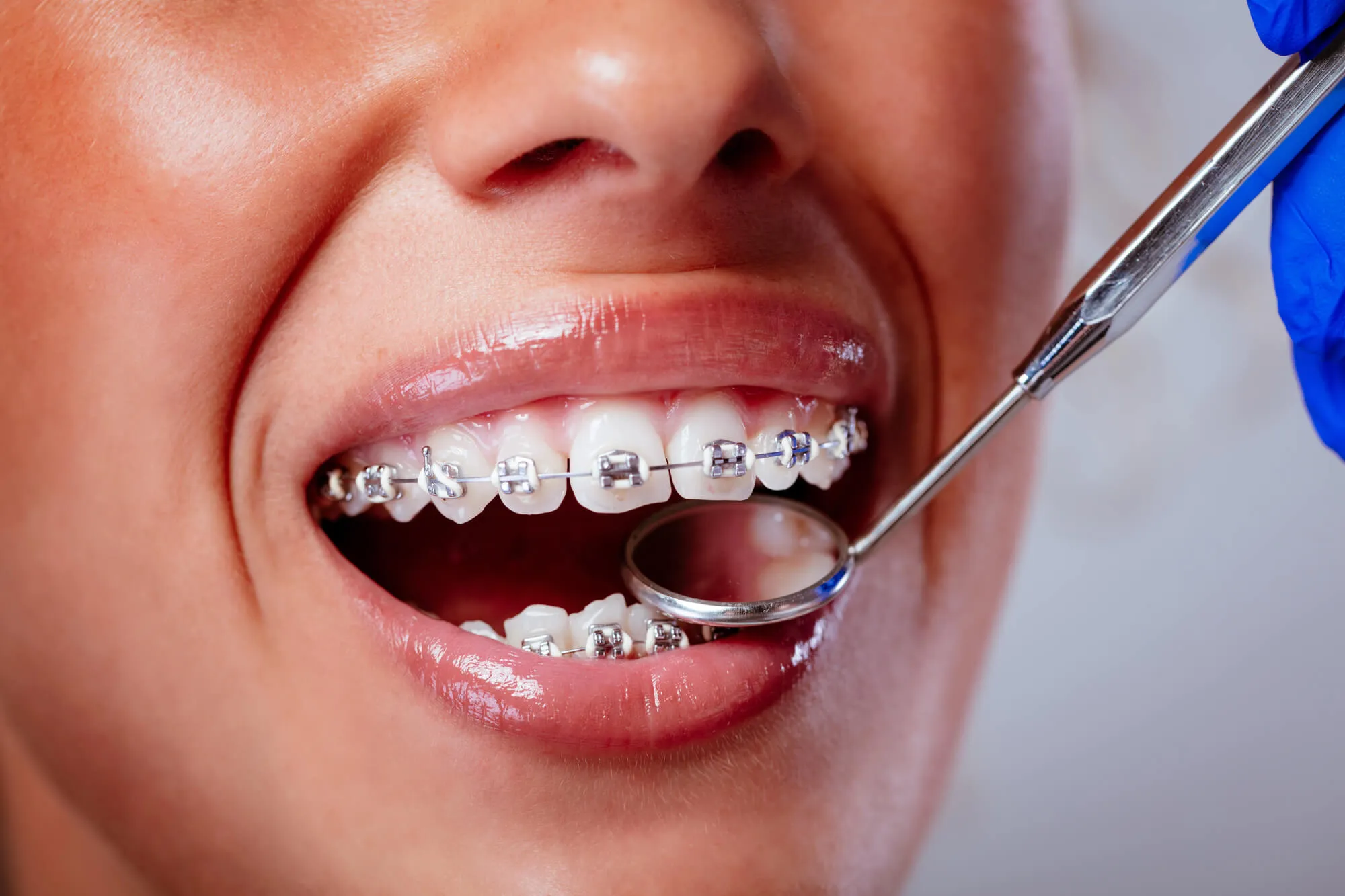 orthodontist spartanburg sc examines braces