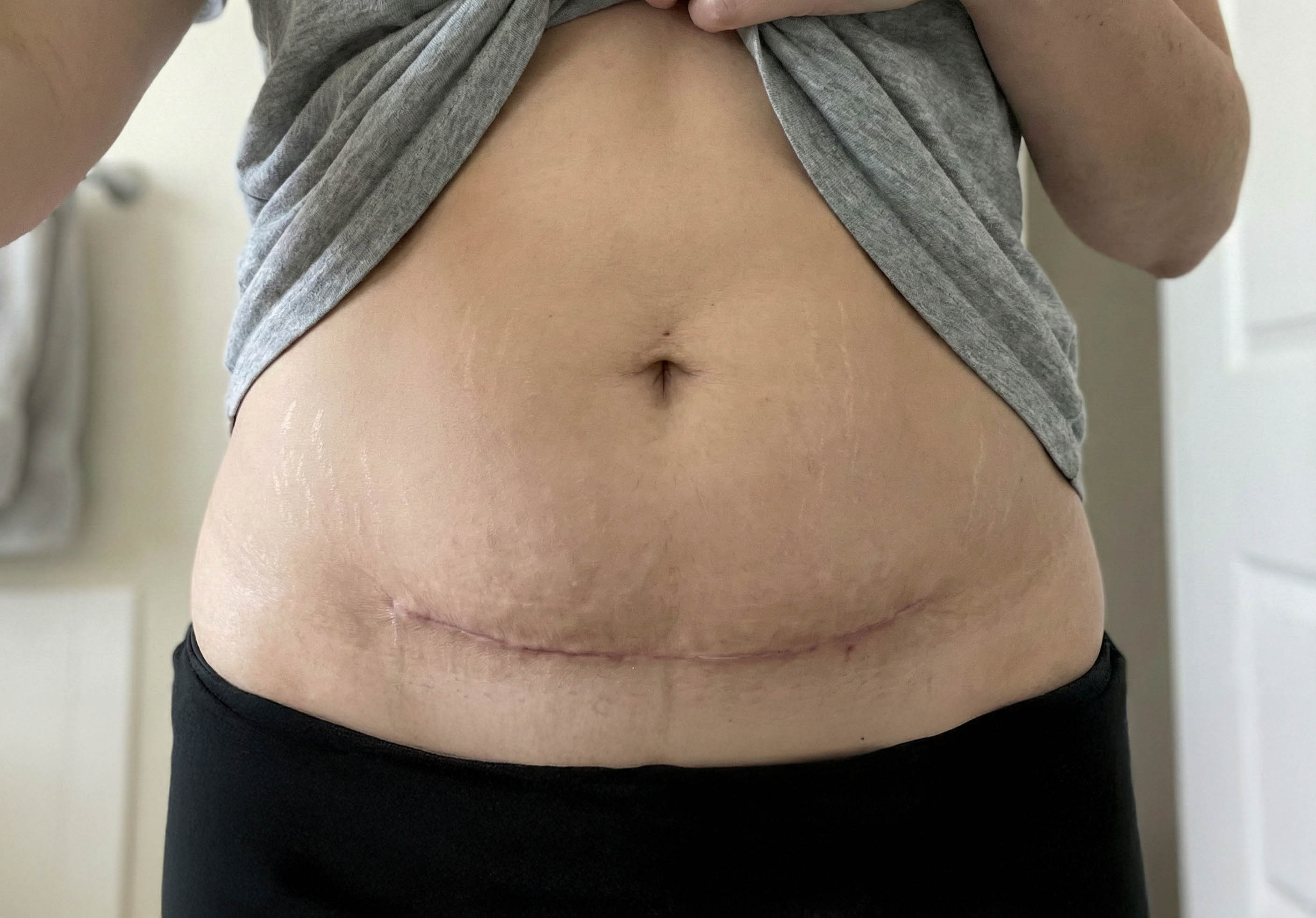Before - tummy tuck scar