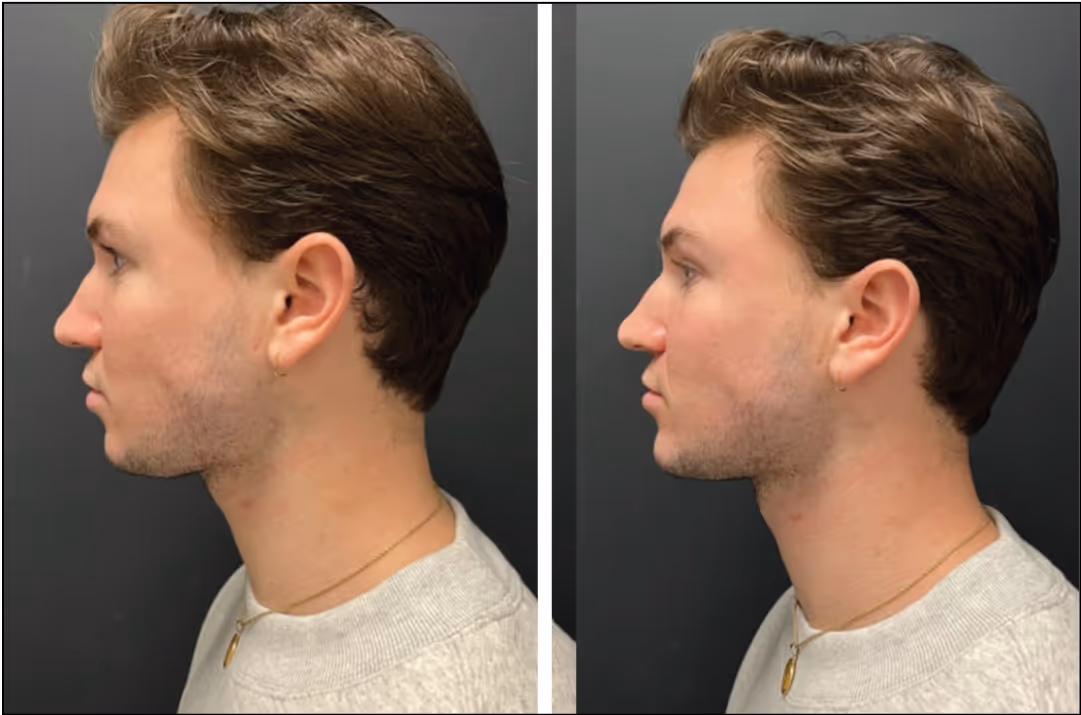 nick-nose-filler_new