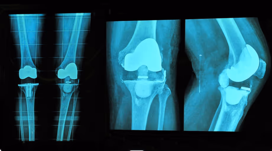 xrays of knee joints