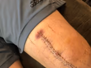 post surgery scars on knee